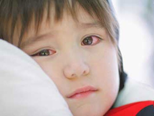 BỆNH ĐAU MẮT ĐỎ VÀ CÁCH PHÒNG BỆNH 