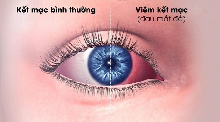 HƯỚNG DẪN CHĂM SÓC KHI MẮC BỆNH ĐAU MẮC ĐỎ