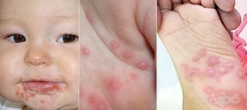 Trung tâm Y tế huyện Tuy An tích cực triển khai công tác Phòng chống bệnh Tay chân miệng 