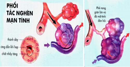 BỆNH PHỔI TẮC NGHẼN MẠN TÍNH