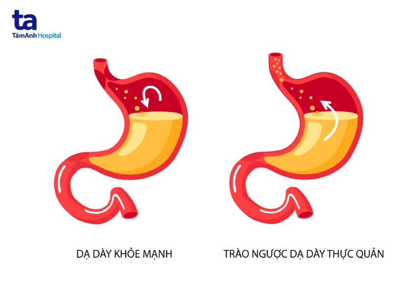 7 thực phẩm nên hạn chế dùng khi bị trào ngược dạ dày - thực quản